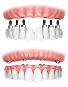 A evolução dos Implantes Dentários