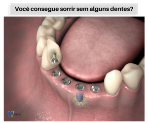 Perda de dente e dificuldade de sorrir