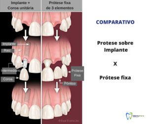 Comparativo: Prótese sobre Implante X Prótese fixa