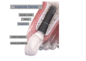 Entendendo o Implante Dental