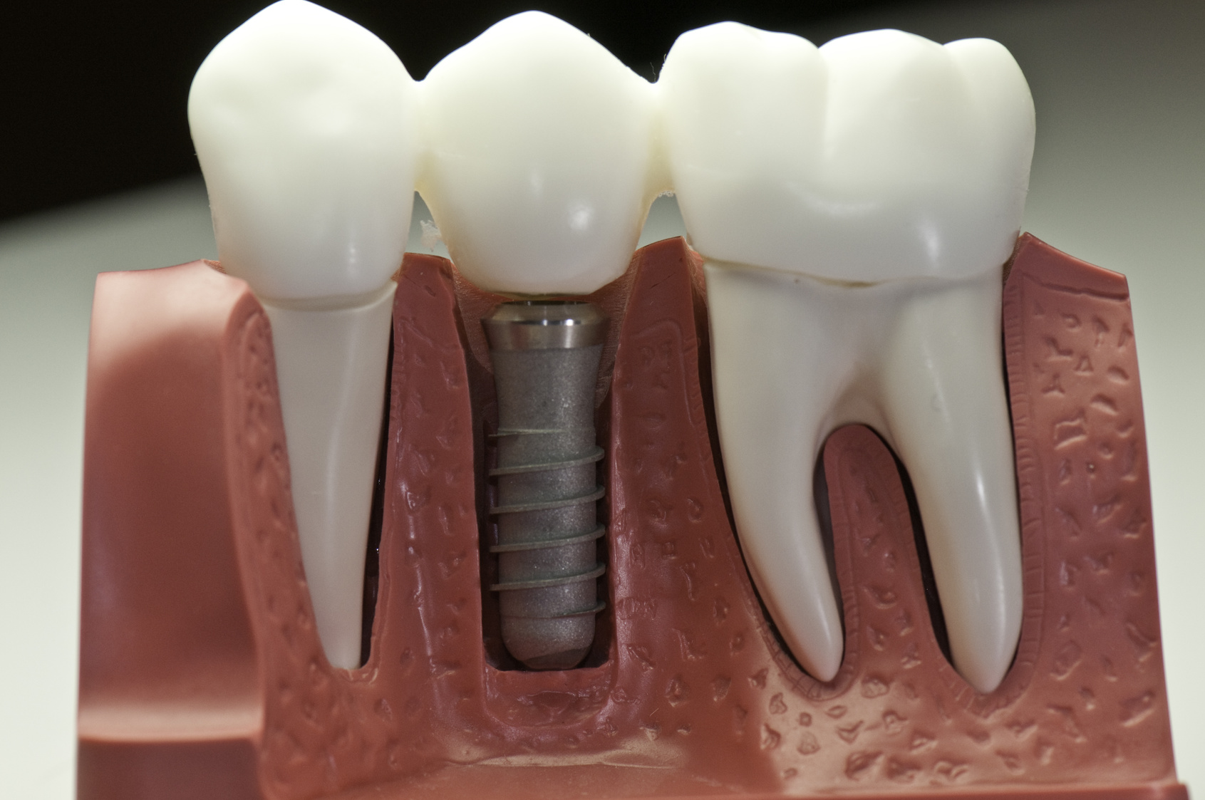 Imagens de Implantes e Próteses Dentárias