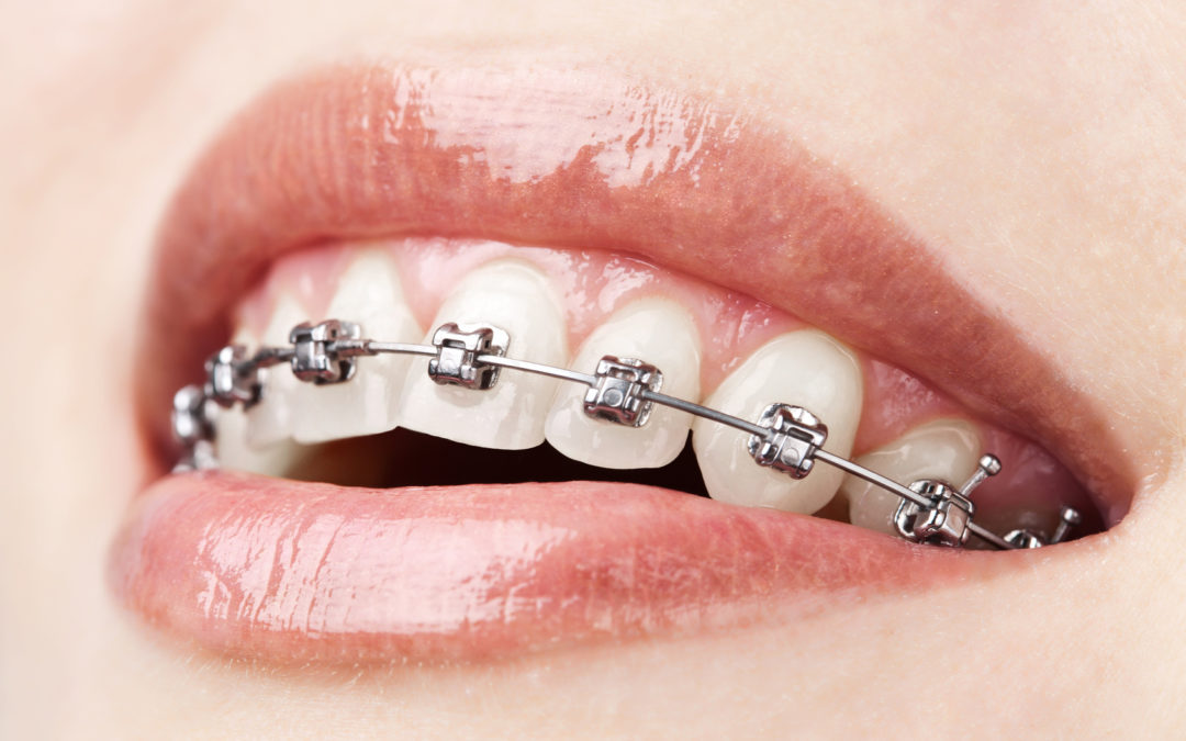 Tratamento ortodontico mais rapido
