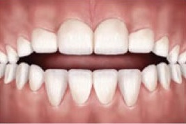 A mordida aberta é quando não existe o contato entre os dentes superiores e inferiores não permitindo a oclusão correta
