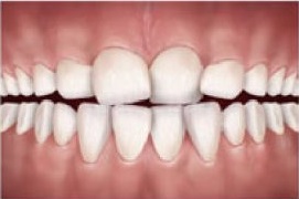 Apinhamento é caracterizado por dentes tortos, devido à falta de espaço