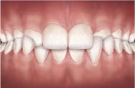 Na mordida ideal os dentes superiores cobrem os inferiores, na mordida cruzada acontece o inverso. 