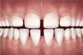 Diastema é o contrário do Apinhamento, ou seja, caracterizado pelo excesso de espaço entre os dentes