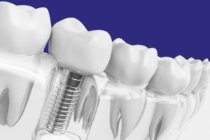 Imagem Demonstrando Um Implante Dentário