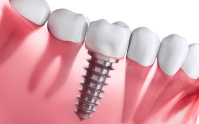 Implantes dentários: para quem não está indicado esse tratamento?