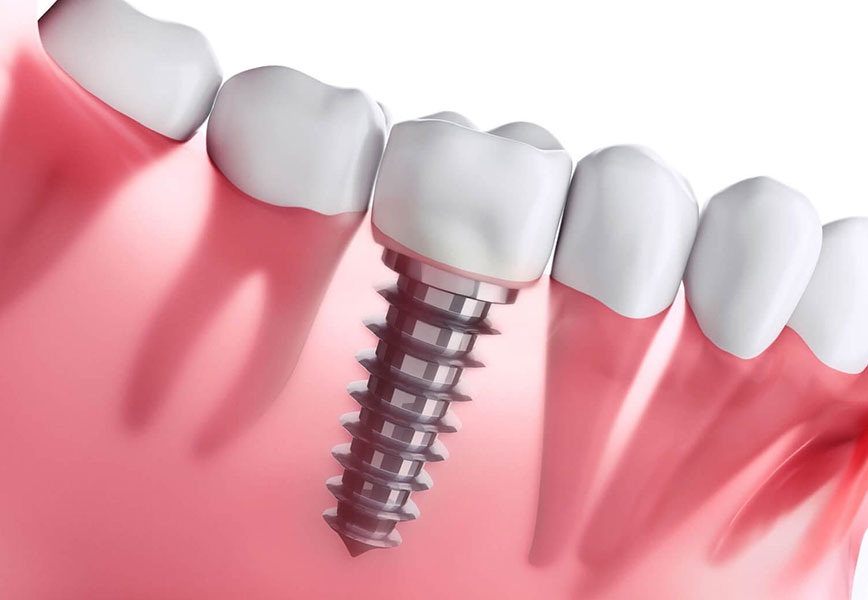 Implantes dentários: para quem não está indicado esse tratamento?